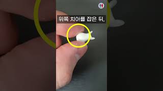 [100만] 이빨이 빠졌을 때... 제발 기억하세요 (평생 후회합니다)