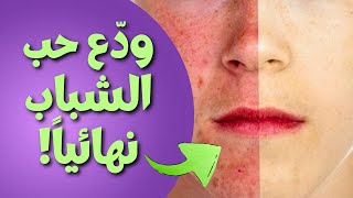 كيف تتخلص من حب الشباب نهائياً ؟