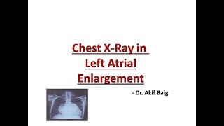 Chest X-ray in left atrial enlargement : Dr. Akif Baig