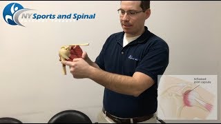 Shoulder Impingement Series- NY Sports & Spinal PT