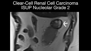 Renal Cell Carcinoma Case 13