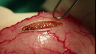 Using the laser to make an incision into a thickened bladder