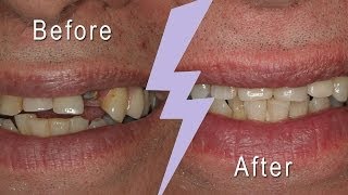 Dental Implant Treatment: Before and After