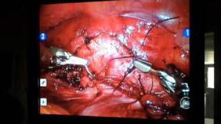 Hysterectomy Using daVinci Technology