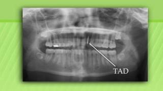 Got Teeth?...TADs For Laterals!