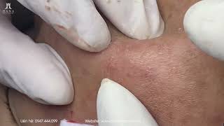 Big Cystic Acne Blackheads Extraction Blackheads & Milia, Whiteheads Removal Pimple Popping