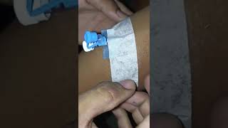 Iv cannula remove #healthfittips #cliniclife #doctor #ivcannula #duet #motivation