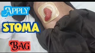 how to apply stoma bag | stoma bag