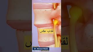 أحذر تمارين الإنزلاق الغضروفى فى حالة تزحزح الفقرات !!#دكتور_احمد_وليد