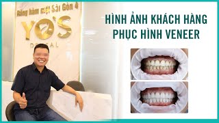 HOÀN THÀNH CASE PHỤC HÌNH VENEER TẠI NHA KHOA SÀI GÒN BÌNH DƯƠNG - CN4.