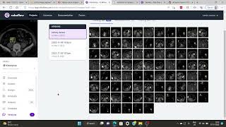 Kidney Tumor Segmentation using YOLOv5 in Pytorch | Stone Segmentation