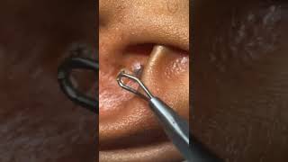 Ear blackheads