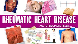 Rheumatic fever | Rheumatic heart disease |definition, causes, presentation and treatment| Sydenham