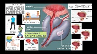 《自然療法與你》- EP711 - 前列腺癌的同類療法