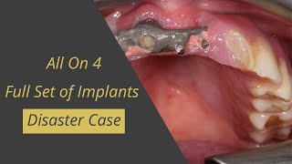 All on 4 Disaster! Problems with a full set of implants