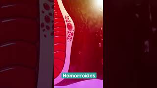 Enfermedad Hemorroidal