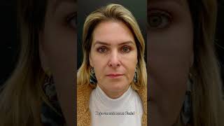 Caso Transformador de Harmonização facial pela Dra Ludmila Grossi.