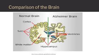 Alzheimer's disease