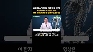 허리디스크 파열 재활치료후기, 극심한 디스크 파열로 인해 다리 마비와 대소변 장애가 온 환자분 #shorts