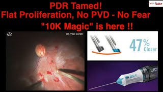 PDR Tamed! No PVD, Flat Fibro-Vascular Proliferation - Managed the "10 K Way!" - Dr Veer Singh