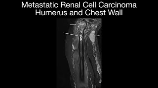 Metastatic Renal Cell Carcinoma