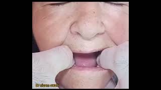 how to fit a dental full denture upper and lower