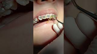 braces power chain remove #beauty #dentalbraces #dentalesthetics #dentition #dentalcare  #smile