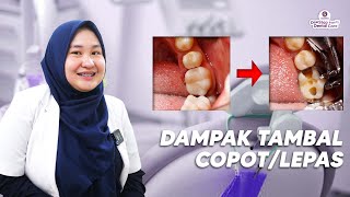 BAHAYA DARI TAMBALAN GIGI YANG LEPAS