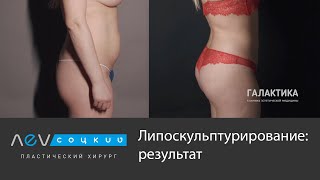 Липоскульптура тела до и после | Лев Соцкий