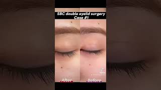 SBC non-incisional double eyelid surgery “QCW technique” #cosmeticsurgery #doubleeyelidsurgery