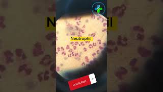 High neutrophil count in peripheral smear | neutrophils | CBC | Causes of Neutrophilia | hematology