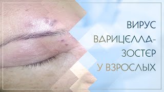 Вирус Варицелла-Зостер у взрослых. Клинический случай №5