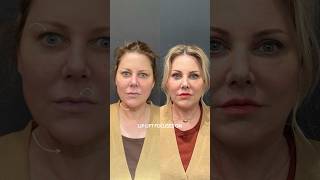 Neck Lift,Lip Lift, and Upper Blepharoplasty!