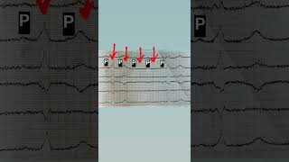 #гипермагнезиемия #экг #экгпроще #ecg