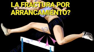 QUÉ ES LA FRACTURA POR ARRANCAMIENTO?