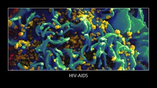 HIV AIDS