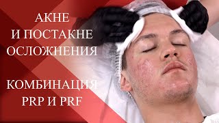 💉Плазмотерапия при папуло-пустулезной форме АКНЕ и ПОСТАКНЕ осложнениях|Тактика лечения