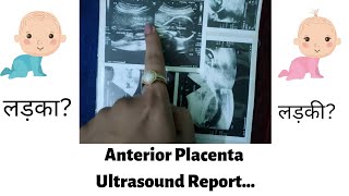 प्लेसेण्टा एंटीरियर और शिशु का जेंडर( अल्ट्रासाउंड रिपोर्ट के साथ )#placenta anterior