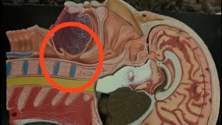 Drug Induced Sleep Endoscopy DISE (Omega Shaped Epiglottis)