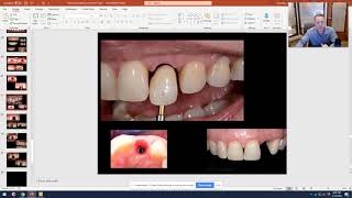 Anterior Temporary Implant Abutments and Crowns.  Education for dental staff.