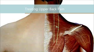 Upper Back Pain... Better, Faster!