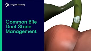 How to Manage Common Bile Duct Stones