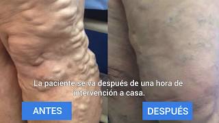 Tratamiento para venas varicosas │Unique Interventional Radiology