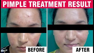 Acne Treatment | Pimple Removal | Acne | Acne Removal | Sakhiya Skin Clinic Review