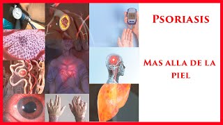 ✅  PSORIASIS mas alla de la Piel: 8 comorbilidades a evaluar en el paciente con psoriasis (2020)👩‍⚕️