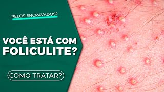 SINAIS E SINTOMAS DA FOLICULITE [APRENDA AGORA]