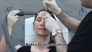 Botox Demonstration 24 Frown Lines - A E Skin - Encino, CA - 818-835-1833