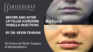 Lip Filler Juvéderm Vobella Injections Long Island, New York by Dr. Kevin Tehrani