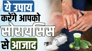 ये 6 उपाय करेंगे सोरायसिस को जड़ से खत्म | Psoriasis Skin Disease Treatment | Psoriasis Ka Ilaj