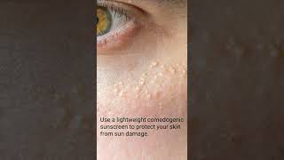 How to prevent Milia, little white bumps under the eyes  #shorts